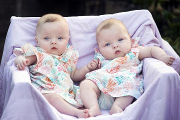 Близнаци спасени со ласерска операција уште во матката